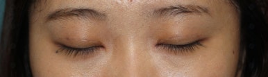 17세 여성, 쌍꺼풀+앞트임(DEO+Medial epicanthoplasty) 관련 이미지 23