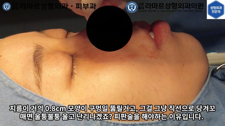 지름 1cm 코 점 제거수술 : 나선피판술(Spiral Flap) 수술전~1달 경과. (Feat. 턱끝필러+사각턱 보톡스) 관련 이미지 62