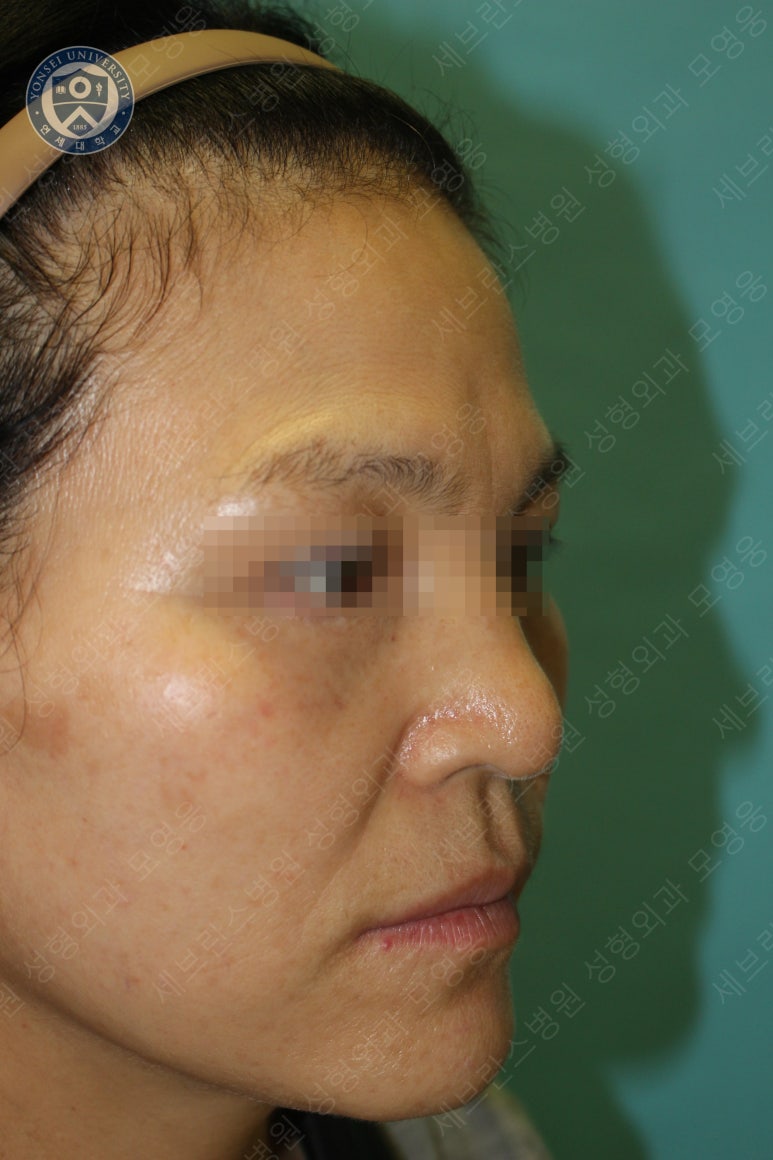 55세 여성, 이중평면 안면거상(55/F, Dual-plane full facelift) 관련 이미지 39