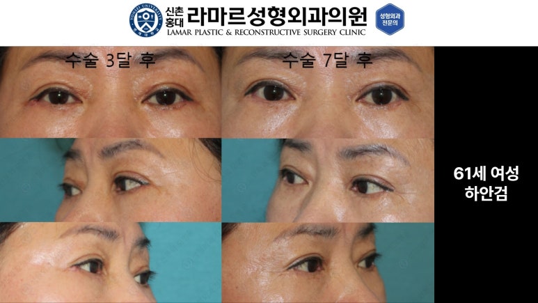 30대~80대 눈 수술 케이스 : 하안검성형술 전후 사진 모음 관련 이미지 14