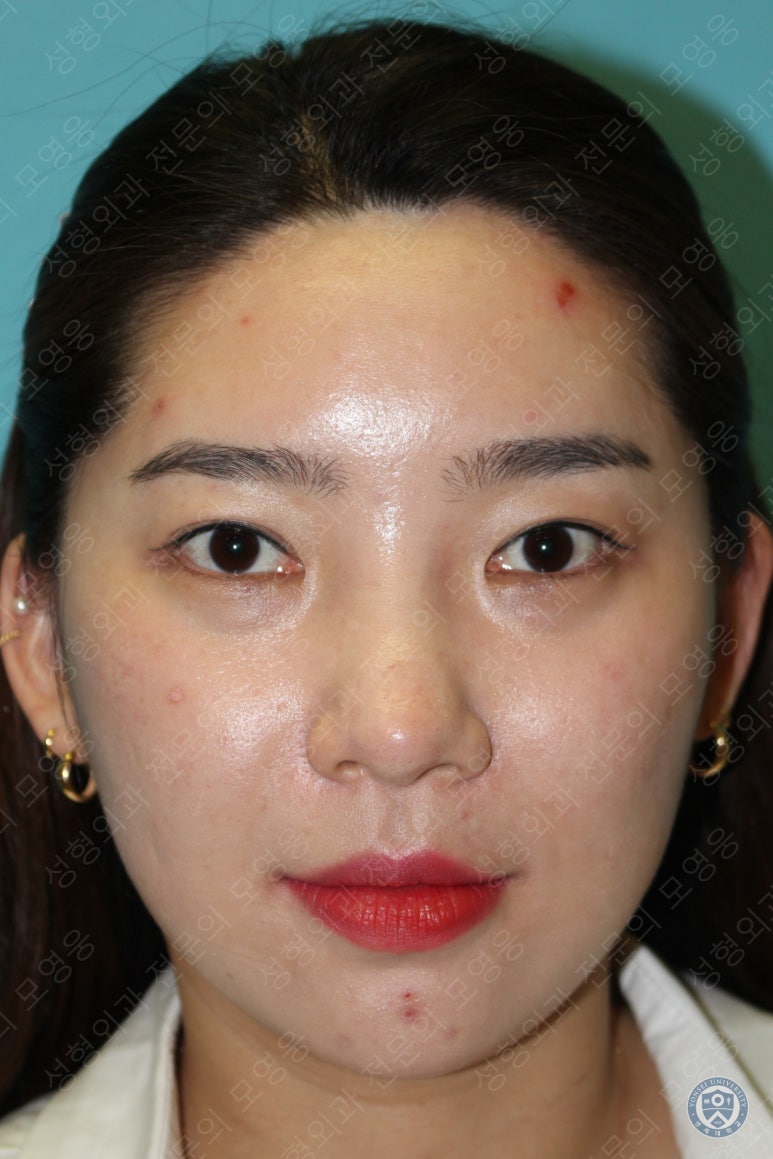 28세 여성 두줄따기, 눈밑지(28/F D.E.O & transconjunctival septal fat redraping) 관련 이미지 2