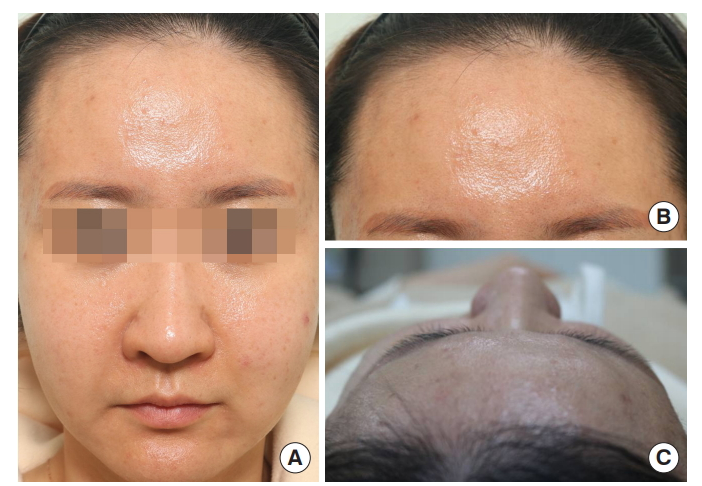 AAPS-Polyacrylamide hydrogel (Aquamid) filler removal after a decade 관련 이미지 8