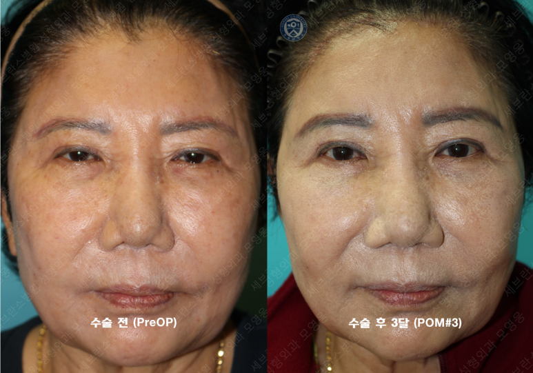 71세 여성, 이마거상술과 이마축소술 (71/F, Forehead lift and reduction) 관련 이미지 57