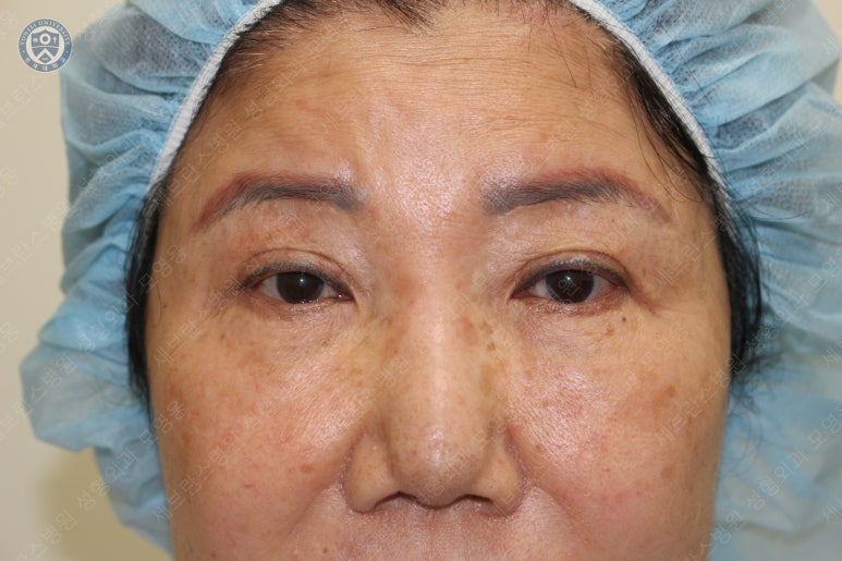 71세 여성, 이마거상술과 이마축소술 (71/F, Forehead lift and reduction) 관련 이미지 12