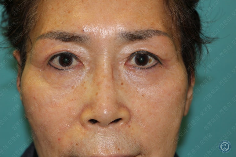 64세 여성 상안검성형술+눈매교정 (64/F Upper blepharoplasty with ptosis correction) 관련 이미지 27