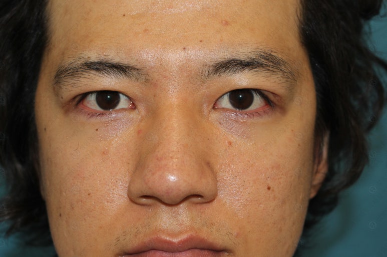 27세 남성 무쌍(속쌍)눈매교정 (27/M Ptosis correction with double lid plasty) 관련 이미지 22