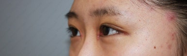 17세 여성, 쌍꺼풀+앞트임(DEO+Medial epicanthoplasty) 관련 이미지 21