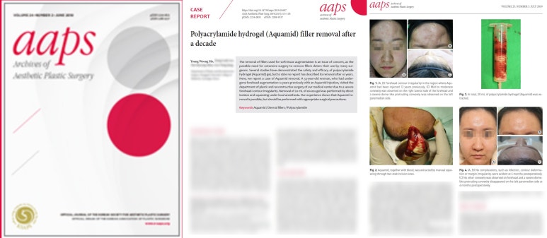 AAPS-Polyacrylamide hydrogel (Aquamid) filler removal after a decade 관련 이미지 10