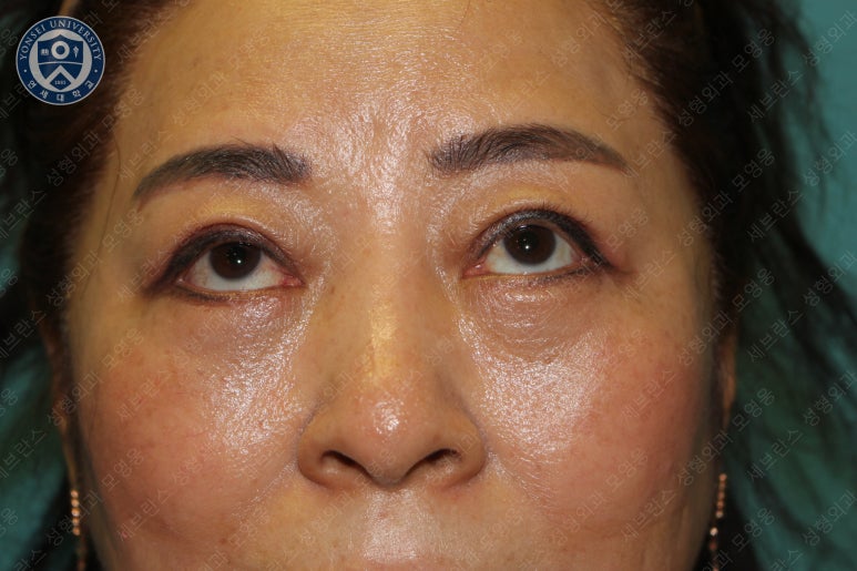 60세 여성, 상안검 및 하안검 성형술 증례 (60/F Upper & lower blepharoplasty) 관련 이미지 25