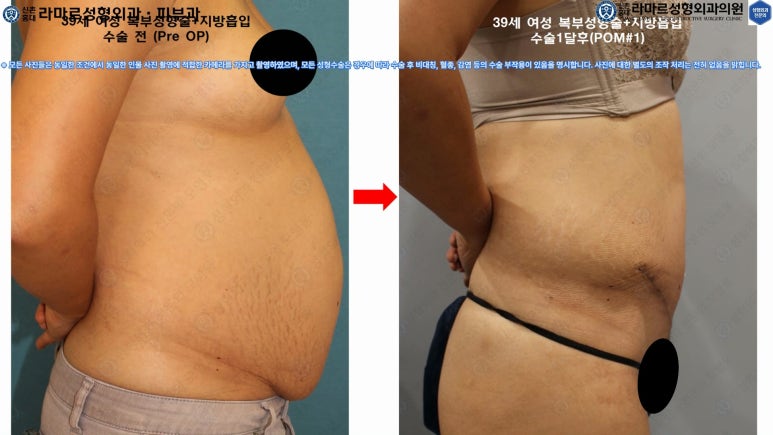 '복부성형술+지방흡입(Abdominoplasty+PAL)' 으로 뱃살 끝장내기! 관련 이미지 58