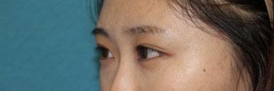 17세 여성, 쌍꺼풀+앞트임(DEO+Medial epicanthoplasty) 관련 이미지 27