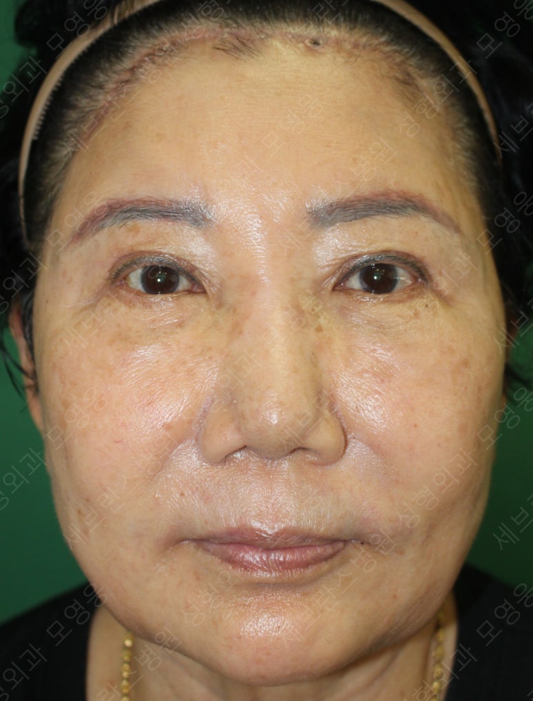 71세 여성, 이마거상술과 이마축소술 (71/F, Forehead lift and reduction) 관련 이미지 29