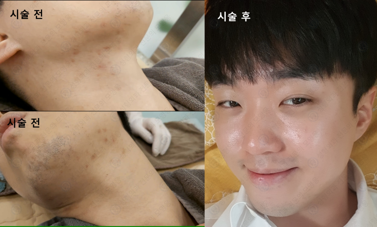 모영웅 대표원장 해초필링(FCR peeling) 피부관리영상...! 멍게피부가 사과피부가 되는 과정을 보여드립니다^^ 관련 이미지 47