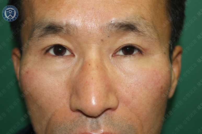 남자눈성형: 무쌍눈매교정 (Blephroptosis correction-levator aponeurosis advancement) 관련 이미지 30