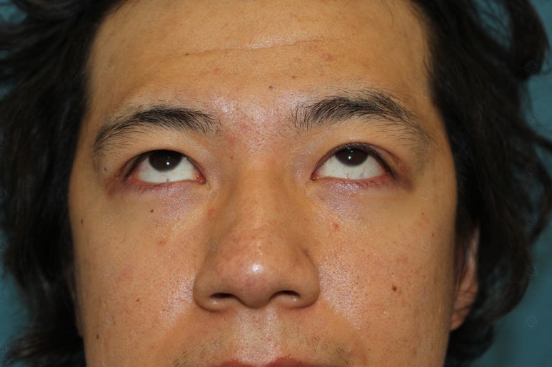 27세 남성 무쌍(속쌍)눈매교정 (27/M Ptosis correction with double lid plasty) 관련 이미지 24