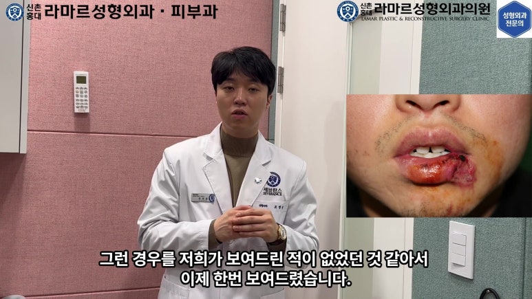 개에 물려 입술 1/3이 뜯긴 19세 남자분 치료 및 흉터 성형수술& 레이저 후기....! 관련 이미지 96