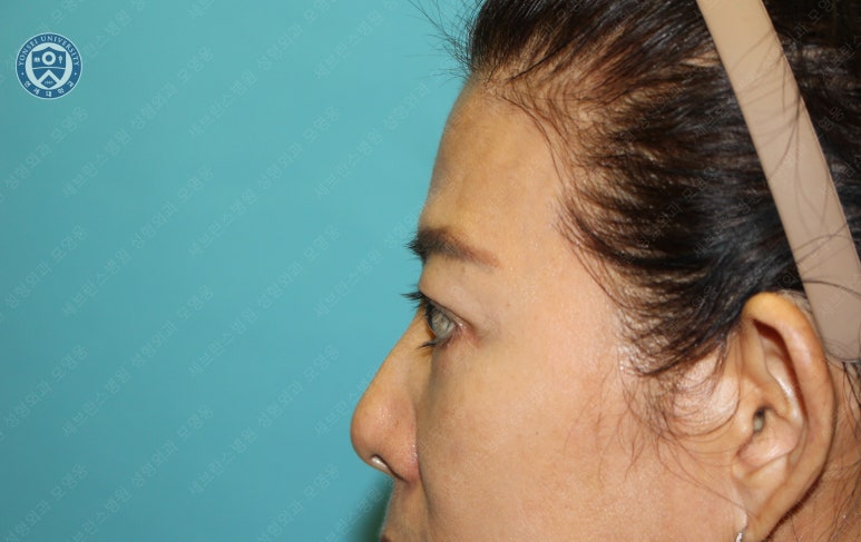 59세 여성, 그레이브스 안병증이 있는 돌출눈 중년 여성 하안검 성형술 (Lower blepharoplasty in Graves 관련 이미지 29