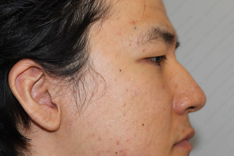 27세 남성 무쌍(속쌍)눈매교정 (27/M Ptosis correction with double lid plasty) 관련 이미지 12