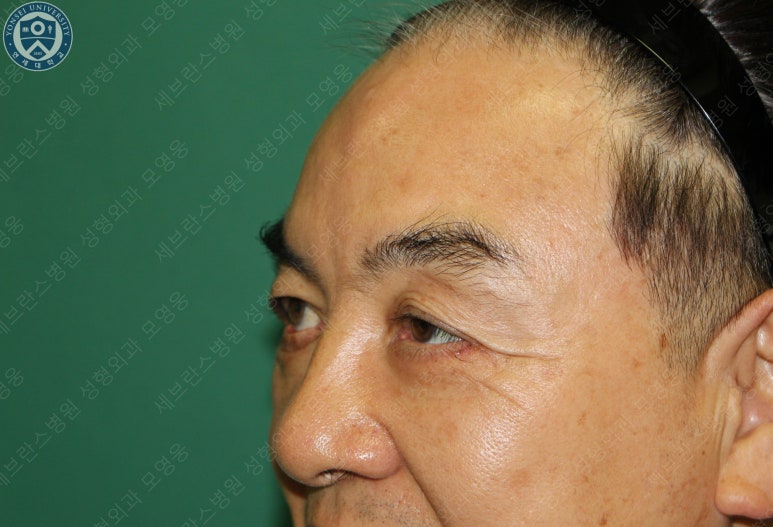 68세 남성, 하안검 성형술 및 안검외반 교정 증례(68/M Lower blepharoplasty & Ectropion correction with triamcinolone) 관련 이미지 10