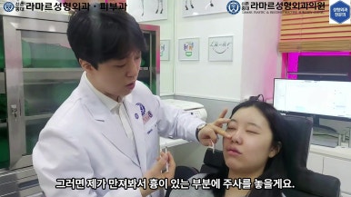 21세 여성 코 지름 1cm 점 제거수술 : 나선피판술(Spiral Flap) 수술전~5달 경과. (+쌍꺼풀수술, 코필러) 관련 이미지 30