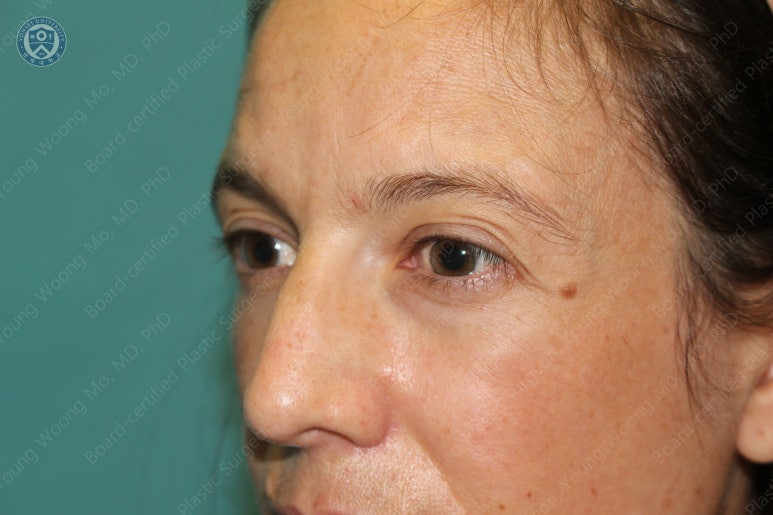 38세 서양 백인 여성, 쌍꺼풀 수술과 눈매교정 및 하안검성형술 (38/F Upper&lower blepharoplasty with levator plication) 관련 이미지 7