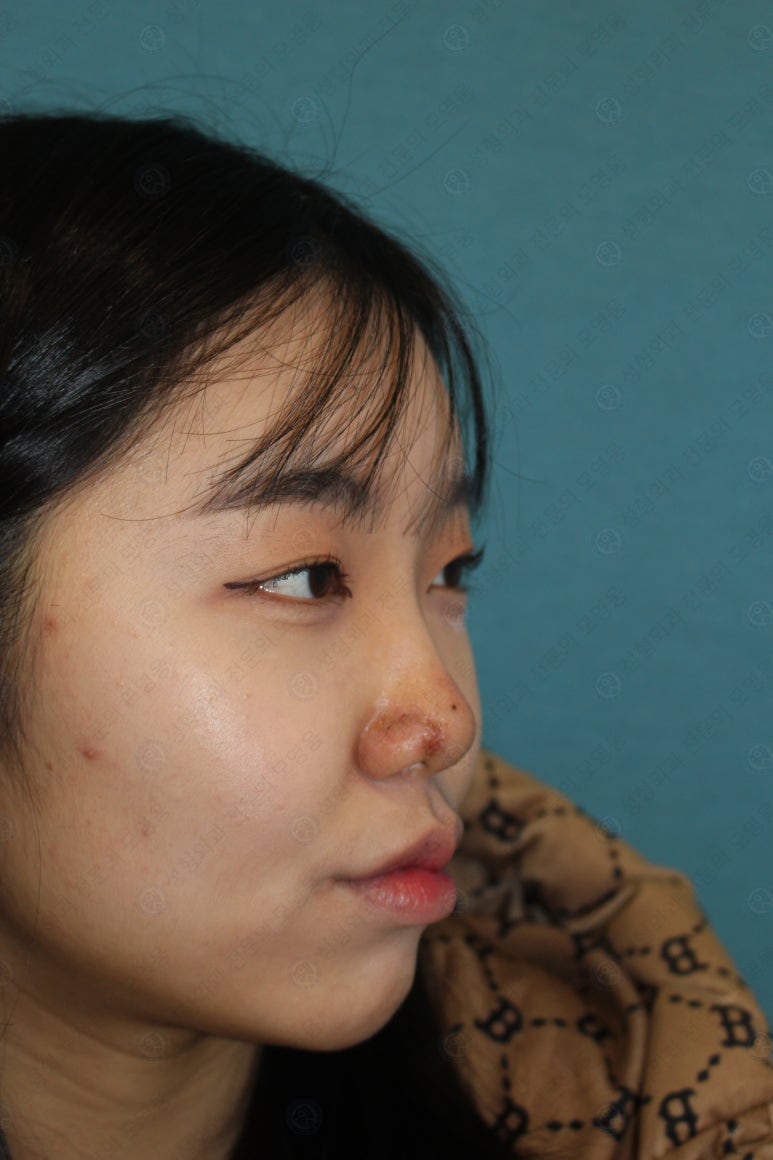 지름 1cm 코 점 제거수술 : 나선피판술(Spiral Flap) 수술전~1달 경과. (Feat. 턱끝필러+사각턱 보톡스) 관련 이미지 118