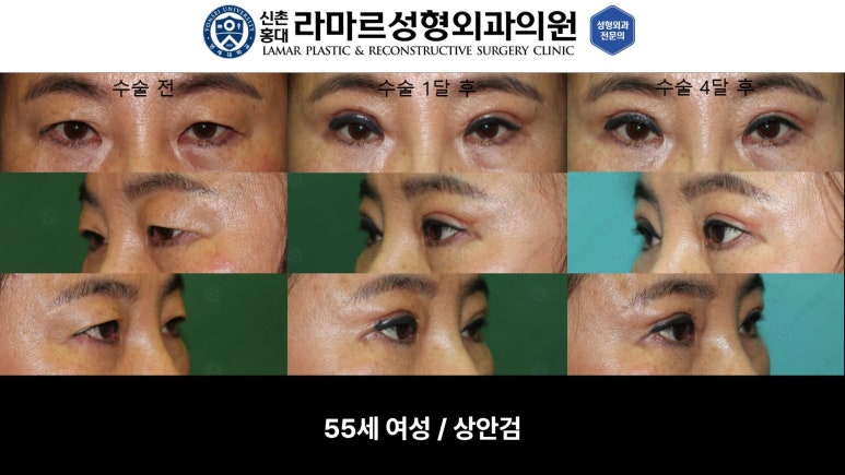 40대~80대 눈 수술 케이스 : 상안검성형술 전후 사진 모음 관련 이미지 20