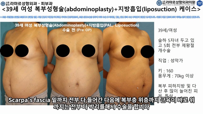 '복부성형술+지방흡입(Abdominoplasty+PAL)' 으로 뱃살 끝장내기! 관련 이미지 32