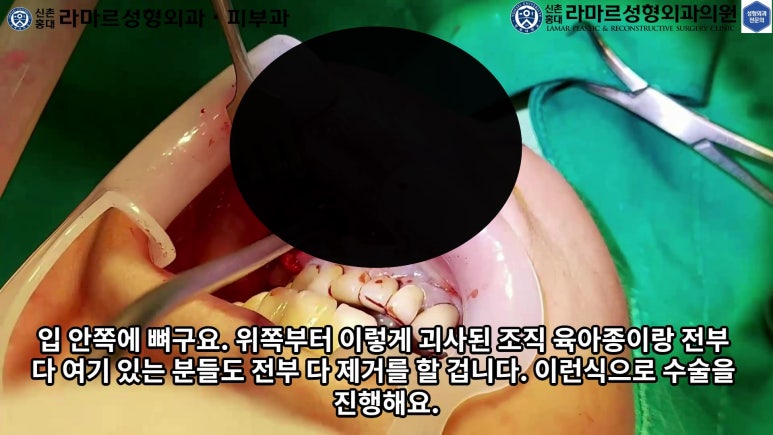 파라핀 필러 입 안 절개로 흉터없이 빼내기! 관련 이미지 26