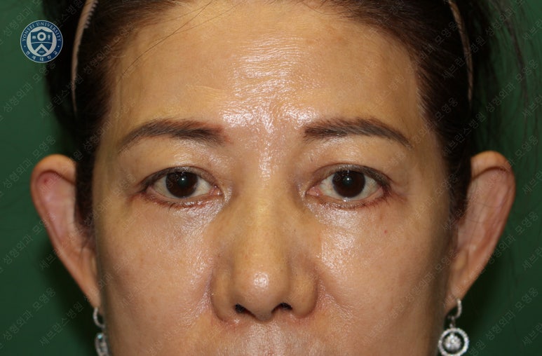59세 여성, 그레이브스 안병증이 있는 돌출눈 중년 여성 하안검 성형술 (Lower blepharoplasty in Graves 관련 이미지 18