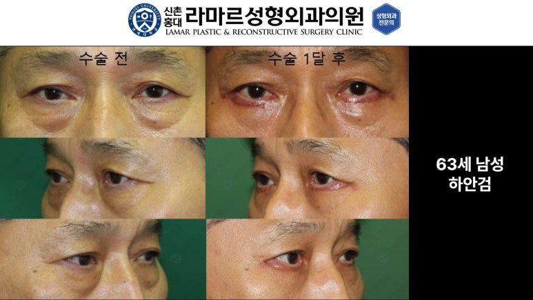 30대~80대 눈 수술 케이스 : 하안검성형술 전후 사진 모음 관련 이미지 21