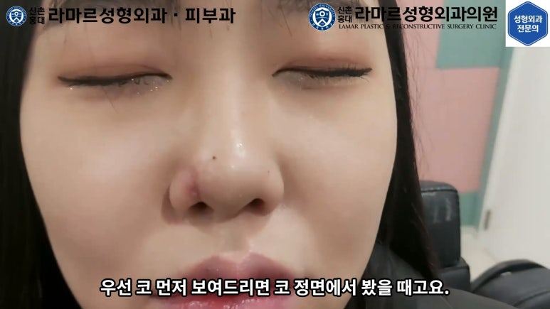지름 1cm 코 점 제거수술 : 나선피판술(Spiral Flap) 수술전~1달 경과. (Feat. 턱끝필러+사각턱 보톡스) 관련 이미지 151