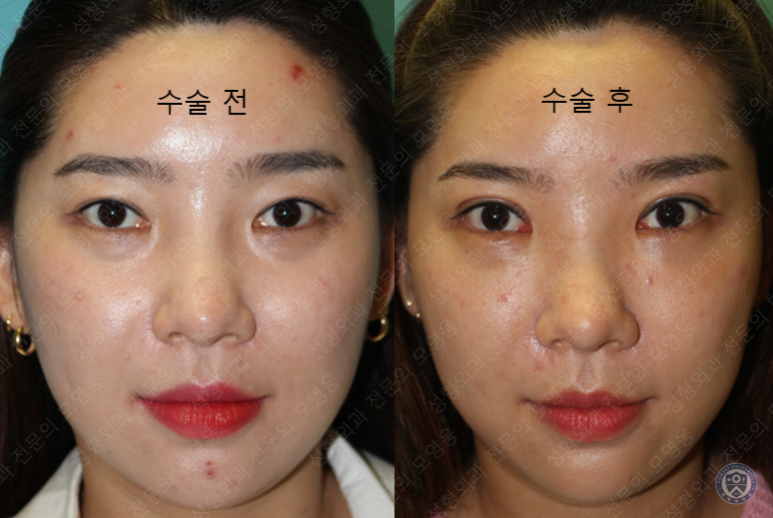 28세 여성 두줄따기, 눈밑지(28/F D.E.O & transconjunctival septal fat redraping) 관련 이미지 18