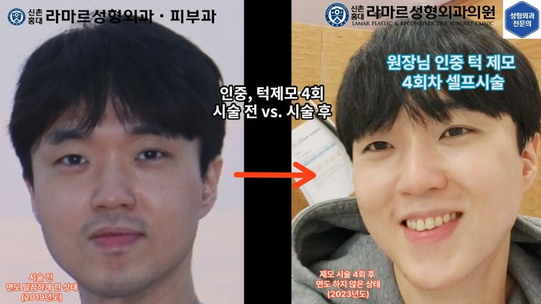 [성형외과 전문의의 셀프시술 제8편] 인중, 아래턱 제모 4회차 결과 공개! 관련 이미지 8