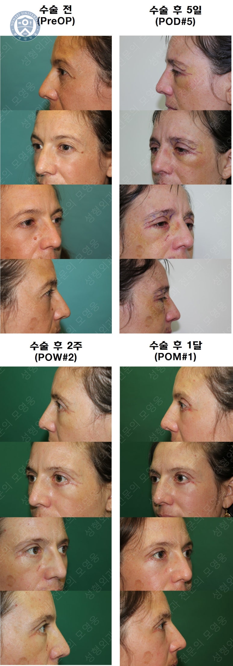 38세 서양 백인 여성, 쌍꺼풀 수술과 눈매교정 및 하안검성형술 (38/F Upper&lower blepharoplasty with levator plication) 관련 이미지 41