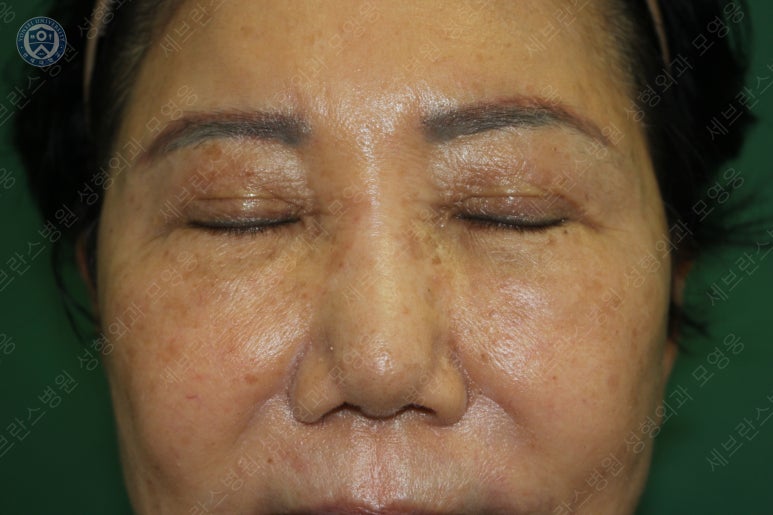 71세 여성, 이마거상술과 이마축소술 (71/F, Forehead lift and reduction) 관련 이미지 31