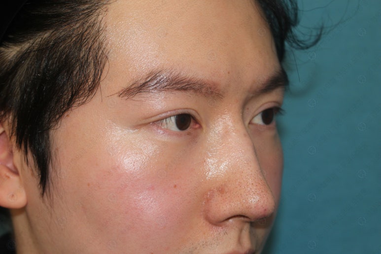 29세 남자, 소시지 쌍꺼풀 두줄따기로 낮추기 (쌍꺼풀 재수술) 관련 이미지 19