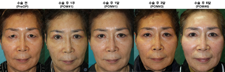 64세 여성 상안검성형술+눈매교정 (64/F Upper blepharoplasty with ptosis correction) 관련 이미지 44