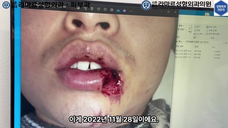 개에 물려 입술 1/3이 뜯긴 19세 남자분 치료 및 흉터 성형수술& 레이저 후기....! 관련 이미지 16