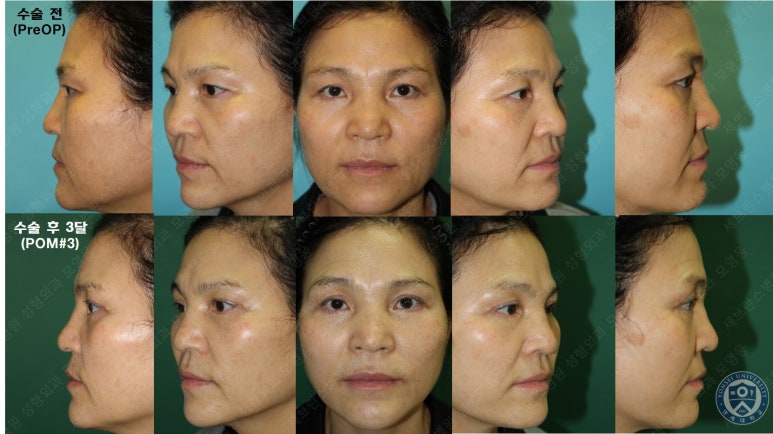 55세 여성, 이중평면 안면거상(55/F, Dual-plane full facelift) 관련 이미지 63