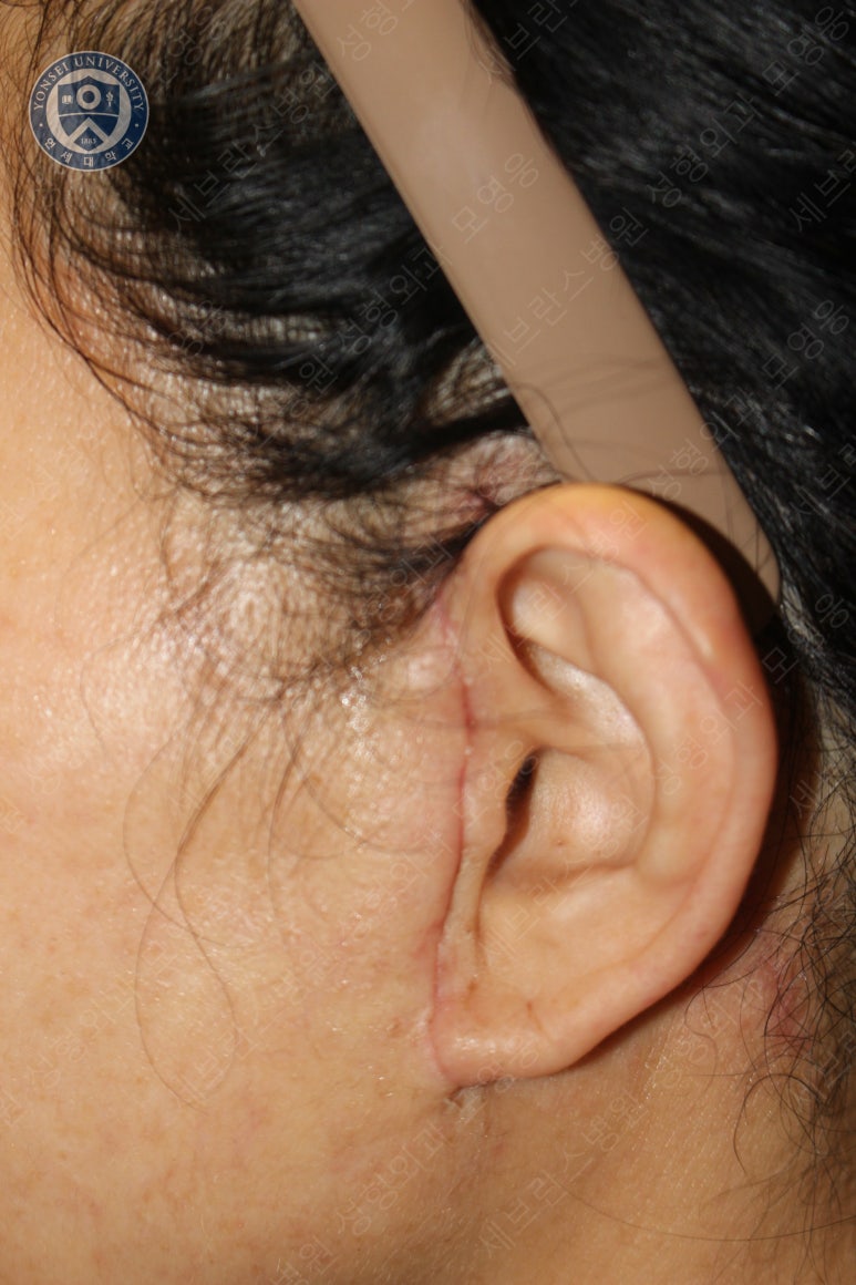 55세 여성, 이중평면 안면거상(55/F, Dual-plane full facelift) 관련 이미지 46