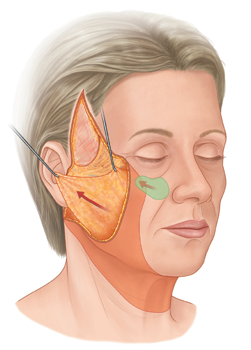 55세 여성, 이중평면 안면거상(55/F, Dual-plane full facelift) 관련 이미지 5