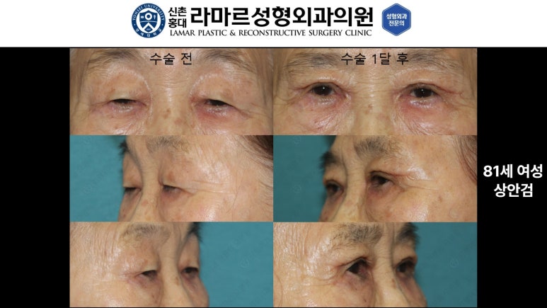 40대~80대 눈 수술 케이스 : 상안검성형술 전후 사진 모음 관련 이미지 15