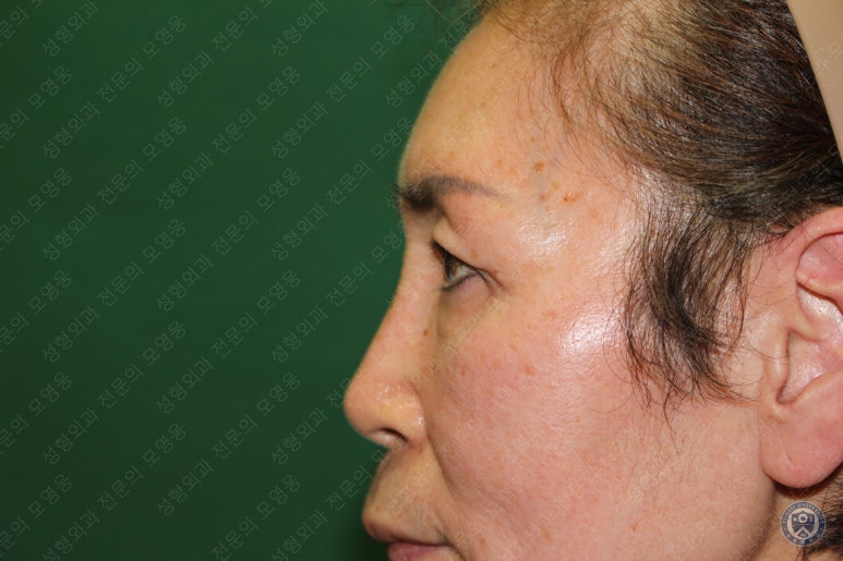 64세 여성 상안검성형술+눈매교정 (64/F Upper blepharoplasty with ptosis correction) 관련 이미지 38