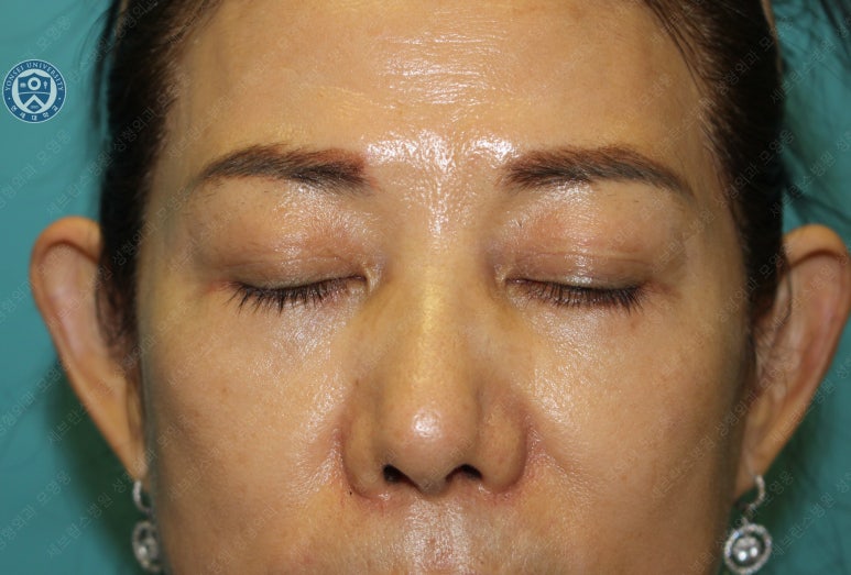 59세 여성, 그레이브스 안병증이 있는 돌출눈 중년 여성 하안검 성형술 (Lower blepharoplasty in Graves 관련 이미지 27