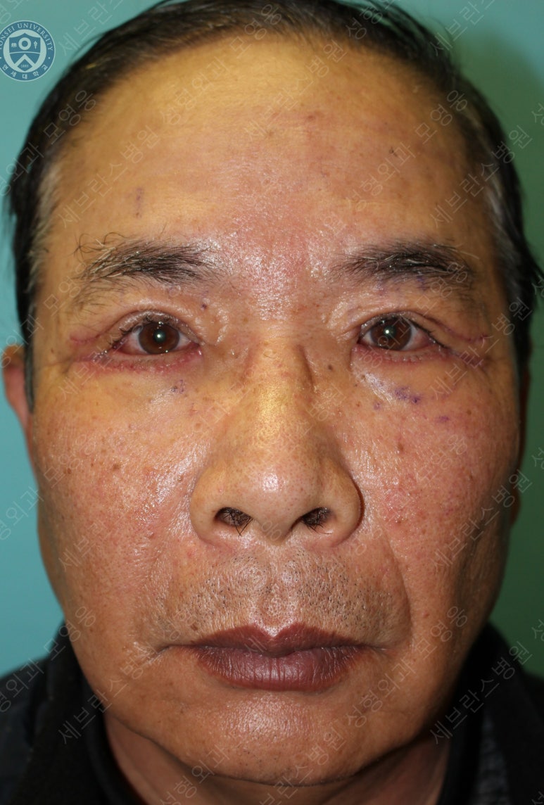 67세 남성, 상&middot;하안검성형술 및 안검하수교정 (67/M, Upper &  lower blepharoplasty with ptosis correction) 관련 이미지 19