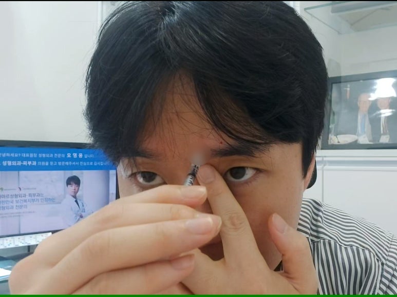 모영웅 대표원장 셀프시술 제6편! 사각턱, 침샘, 미간, 자갈턱 보톡스~! 전체 시술과정 공개합니다 관련 이미지 21