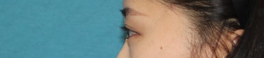 17세 여성, 쌍꺼풀+앞트임(DEO+Medial epicanthoplasty) 관련 이미지 48