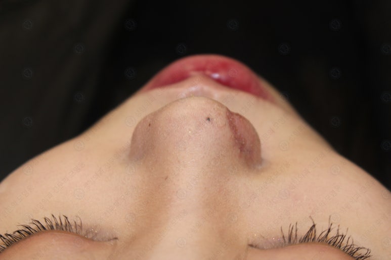 지름 1cm 코 점 제거수술 : 나선피판술(Spiral Flap) 수술전~1달 경과. (Feat. 턱끝필러+사각턱 보톡스) 관련 이미지 188