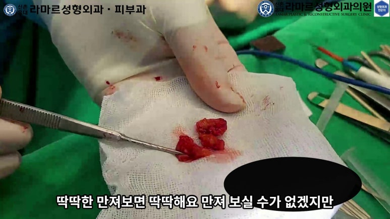 파라핀 필러 입 안 절개로 흉터없이 빼내기! 관련 이미지 51
